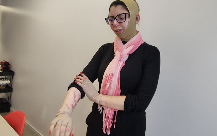 Sete meses após o acidente em restaurante, Samy ainda tem um longo caminho até a reabilitação (Foto: Fran Marcon)