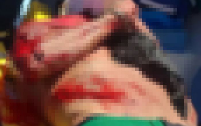 Gravemente ferido, ele caiu ao lado da mureta que divide as pistas da rodovia / Bombeiros Voluntários / Divulgação