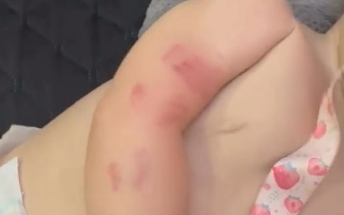 Mãe critica falta de aviso da creche após bebê ser mordida (Foto: Reprodução)